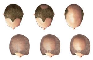 Baldness in men and women image