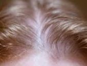 Female hair loss picture