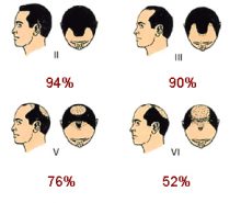 Male pattern baldness image